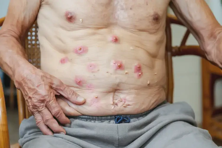 老年人肚子起濕疹不管它會(huì)自己好嗎(圖4)