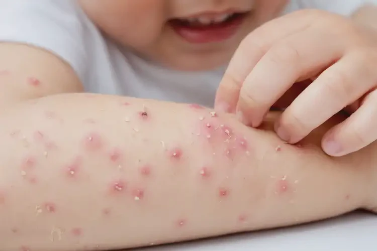 小兒手臂上出現(xiàn)濕疹能靠自己自愈嗎(圖4)