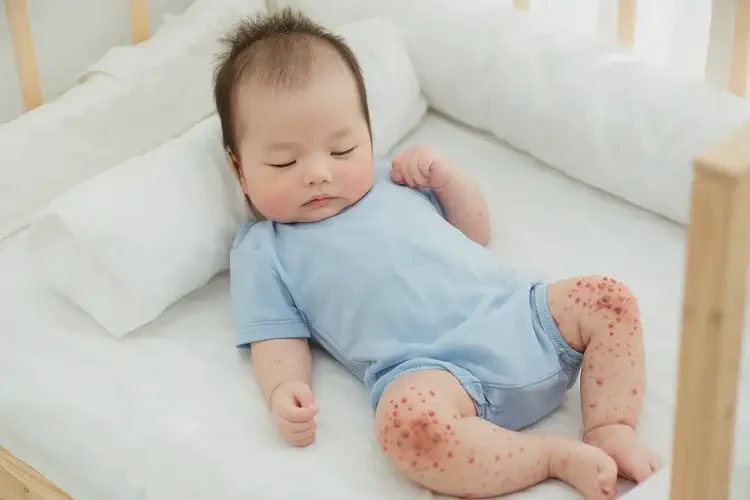 寶寶四肢出濕疹不管它會(huì)自己好嗎(圖3)