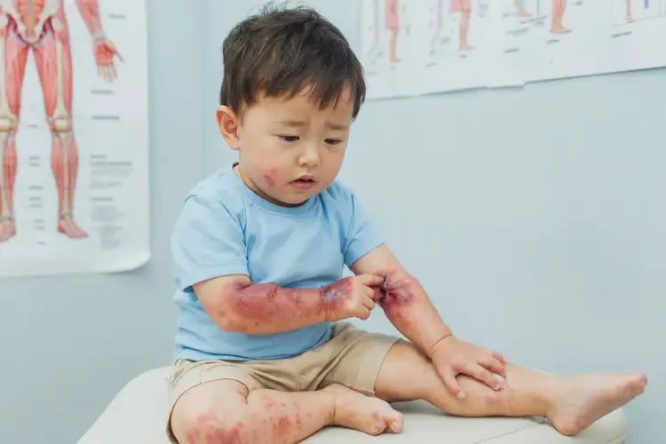 幼兒四肢容易起濕疹不管它會自己自愈嗎(圖4)