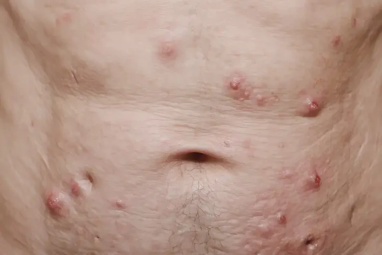 老人肚子容易起濕疹能夠徹底治愈嗎(圖4)