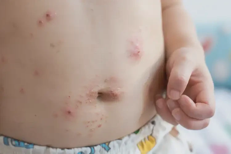 小孩肚子上經(jīng)常起濕疹不管它會(huì)自己好嗎(圖4)