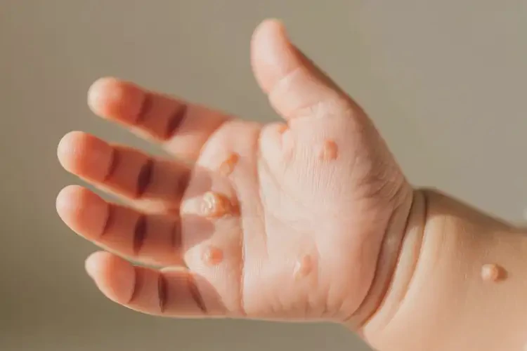 寶寶手上有濕疹能夠徹底治愈嗎(圖4)