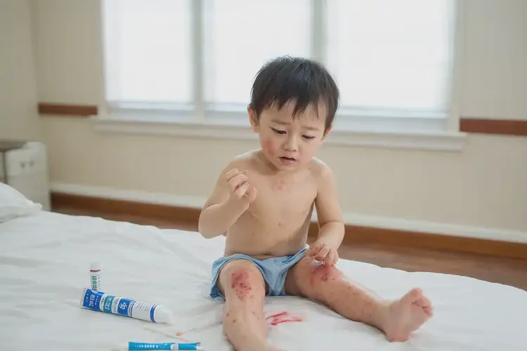 小兒大腿出現(xiàn)濕疹能徹底自愈嗎(圖4)