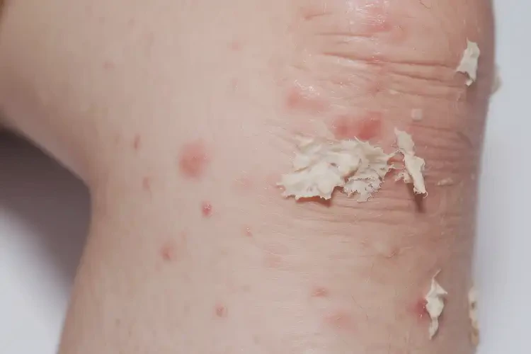 小孩大腿上出現(xiàn)濕疹不管它會自己好嗎(圖2)