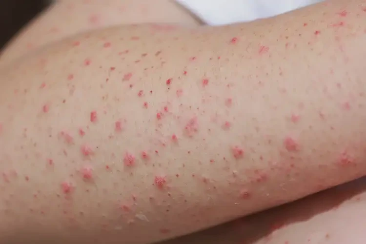 兒童手臂上容易起濕疹可以徹底自愈嗎(圖4)