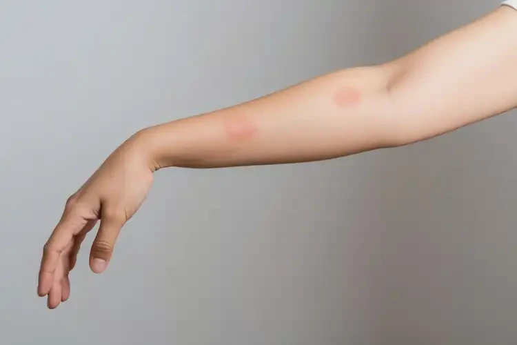 產(chǎn)婦手臂經(jīng)常長濕疹可不可以徹底自愈(圖2)