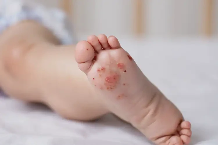 嬰幼兒腳上容易起濕疹不管它會(huì)自己自愈嗎(圖4)
