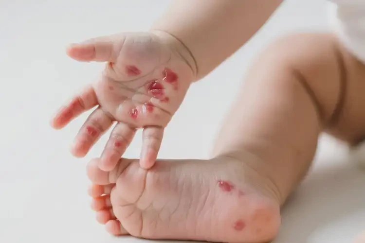 婴儿四肢偶尔长湿疹可不可以彻底自愈(图1)