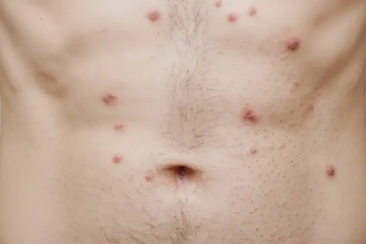 青年人肚子上有濕疹能徹底自愈嗎(圖4)