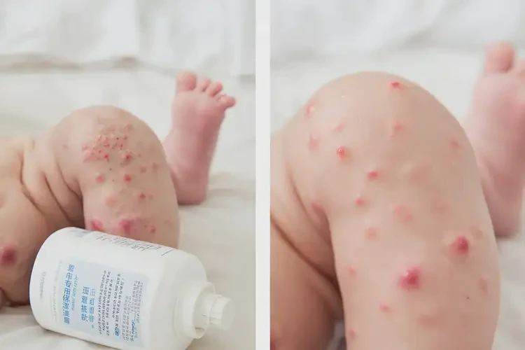 新生兒小腿上容易起濕疹可不可以徹底自愈(圖1)