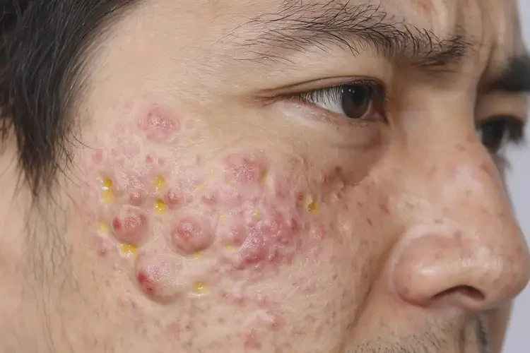 青年人面部出現(xiàn)濕疹不管它會(huì)自己痊愈嗎(圖4)