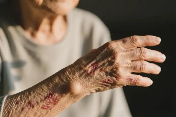 老人手臂上經(jīng)常起濕疹不管它會自己自愈嗎(圖2)