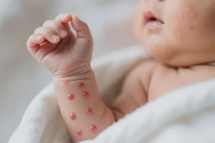 新生兒手臂容易起濕疹不管它會(huì)自己自愈嗎(圖3)
