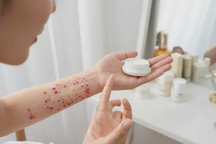 產(chǎn)婦手上出現(xiàn)濕疹可以徹底自愈嗎(圖3)