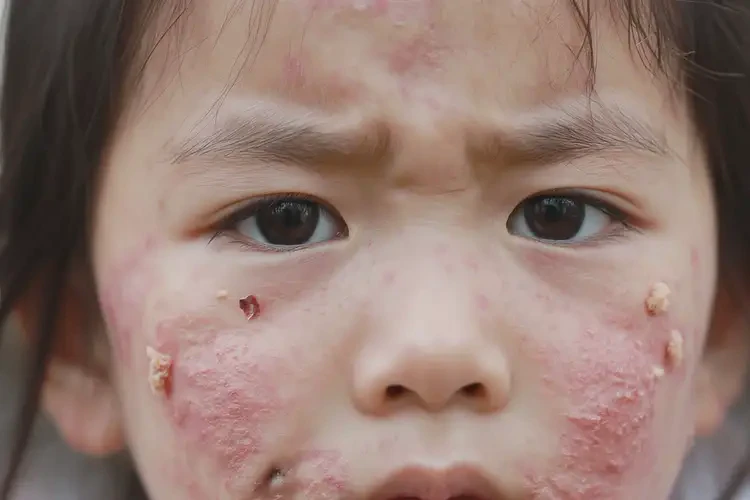 儿童脸上出湿疹不管它会自己痊愈吗(图4)