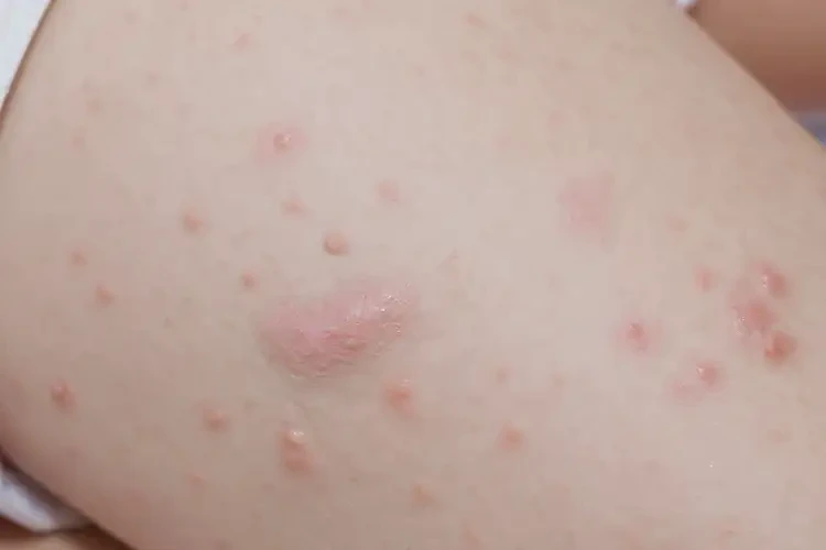 孩子大腿長(zhǎng)濕疹能夠徹底治愈嗎(圖4)