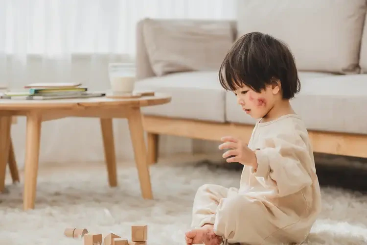 兒童手臂上容易起濕疹可以徹底自愈嗎(圖1)