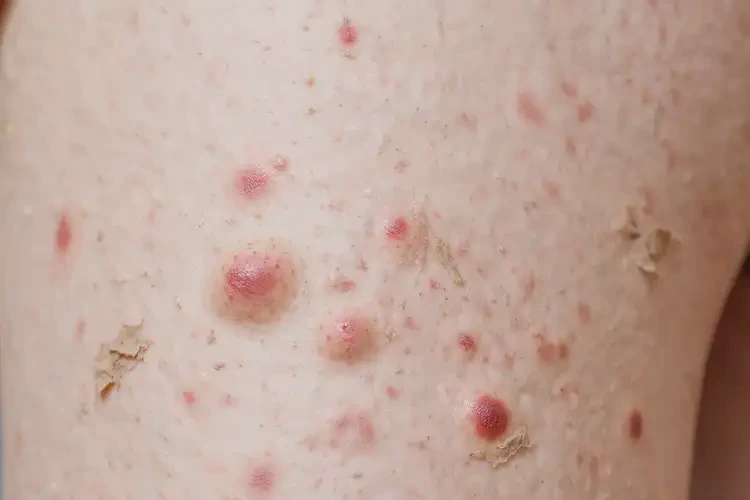 產(chǎn)婦小腿上出現(xiàn)濕疹能夠徹底治愈嗎(圖4)