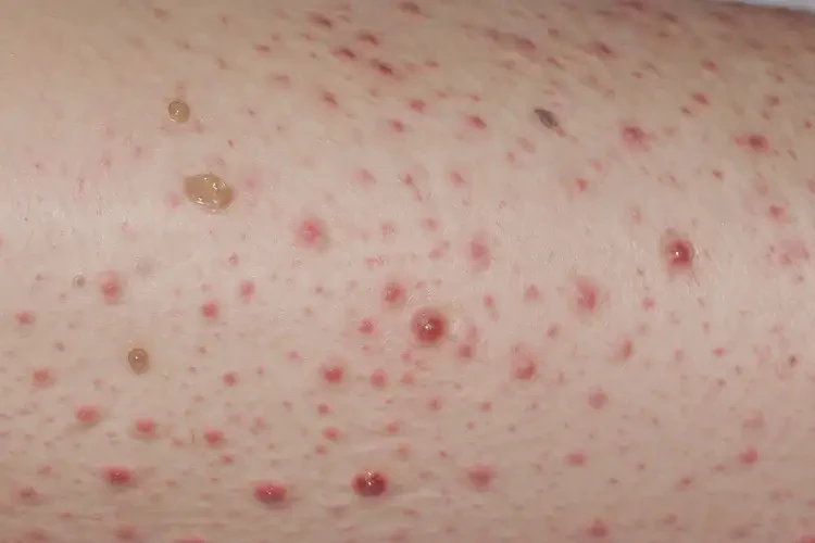 中學生小腿經(jīng)常起濕疹可以徹底自愈嗎(圖4)