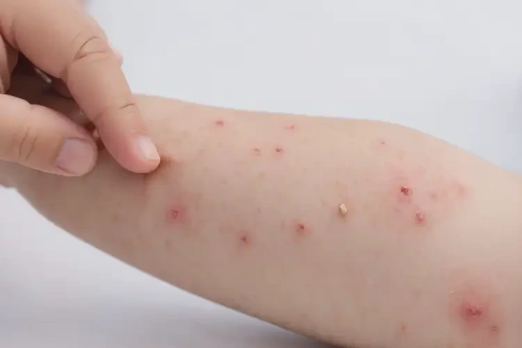 兒童全身經(jīng)常長濕疹不管它會(huì)自己自愈嗎(圖4)