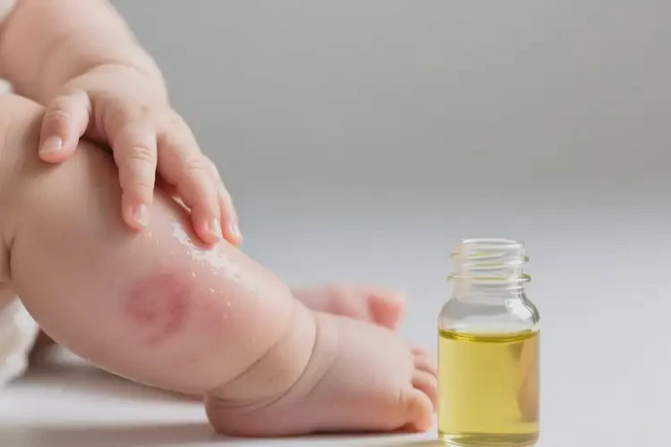 嬰兒小腿上有濕疹不管它會(huì)自己痊愈嗎(圖2)