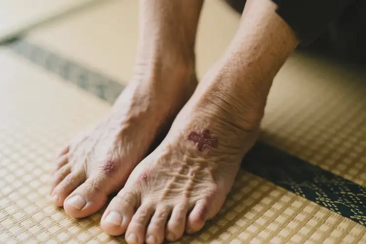 高齡老人腳上出濕疹不管它會自己自愈嗎(圖1)