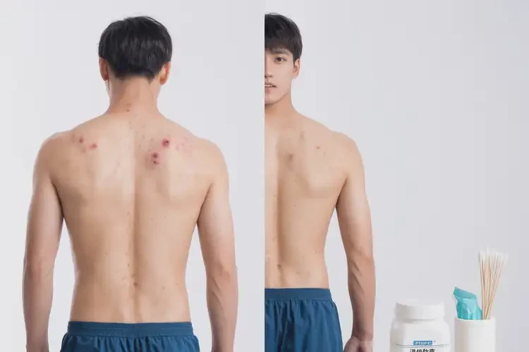 青年人屁股上出濕疹能不能徹底自愈(圖3)