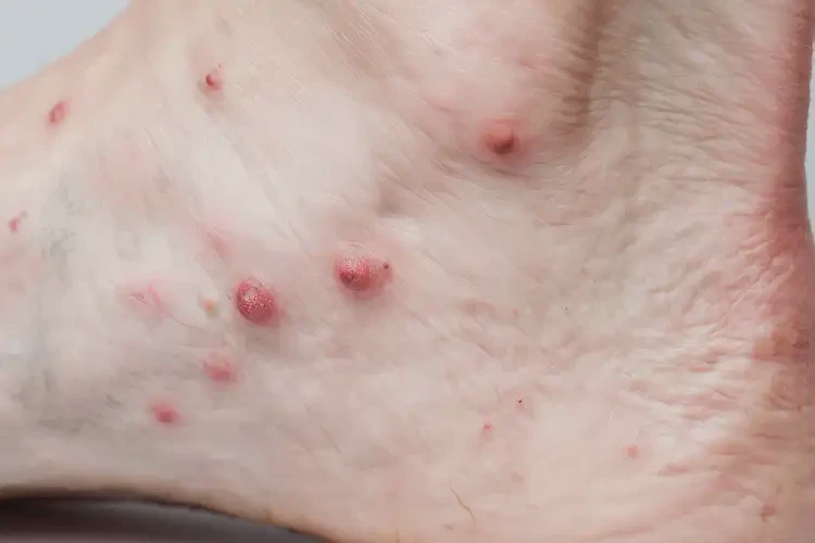 男人腳上容易長濕疹可不可以徹底自愈(圖4)