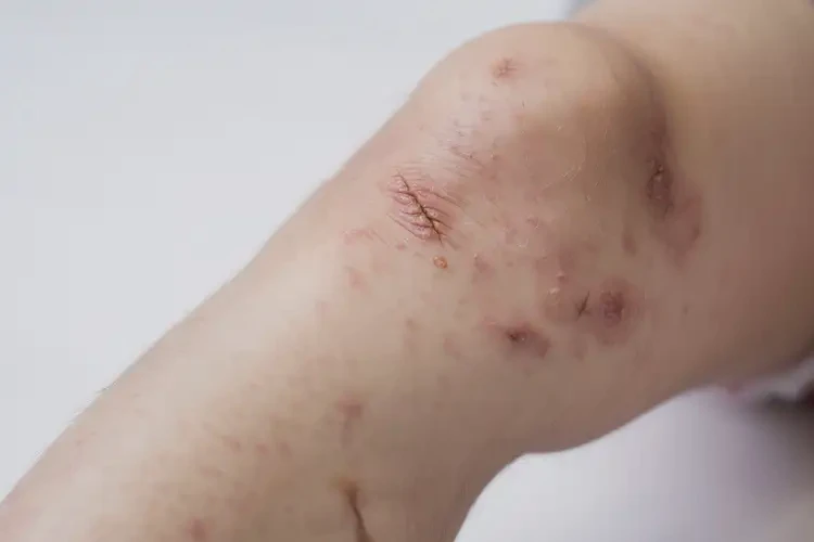 小孩大腿上出現(xiàn)濕疹不管它會自己好嗎(圖3)