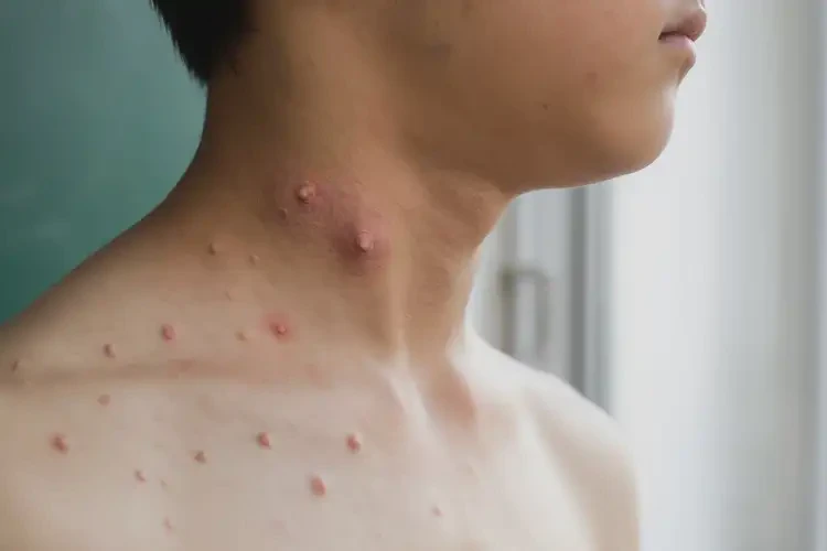 中学生脖子有湿疹不管它会自己痊愈吗(图4)