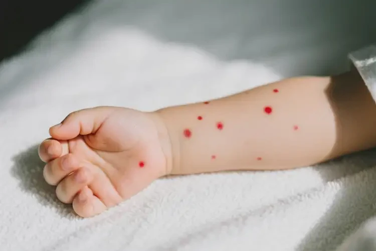 少兒手臂上偶爾長濕疹不管它會自己好嗎(圖2)