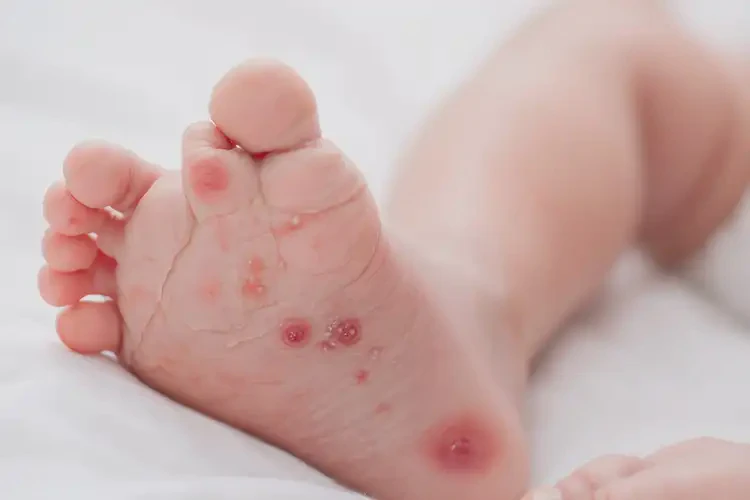 新生兒腳上出現(xiàn)濕疹能徹底自愈嗎(圖4)