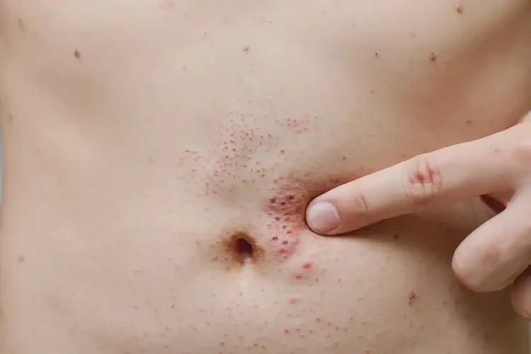 青少年肚子上出濕疹不管它會(huì)自己自愈嗎(圖4)