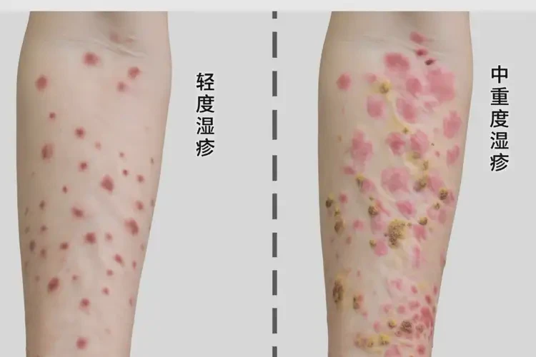 男生大腿起濕疹能靠自己自愈嗎(圖3)