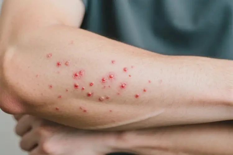 男性身上偶尔起湿疹能靠自己自愈吗(图2)