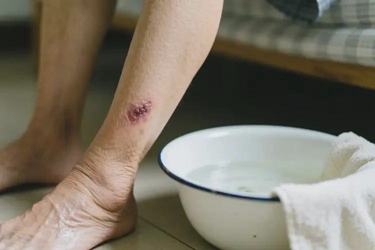 老年人小腿上偶尔长湿疹能够彻底治愈吗(图2)