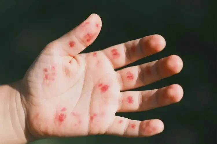 小孩手上長濕疹能徹底自愈嗎(圖3)