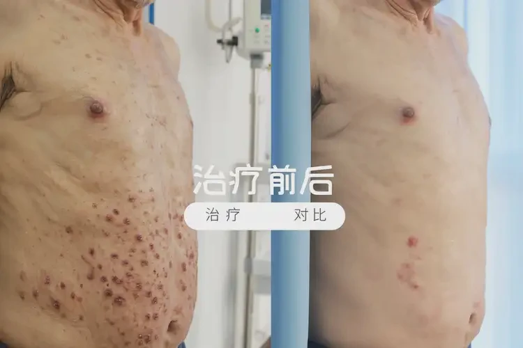 高齡老人肚子偶爾起濕疹能不能徹底自愈(圖1)