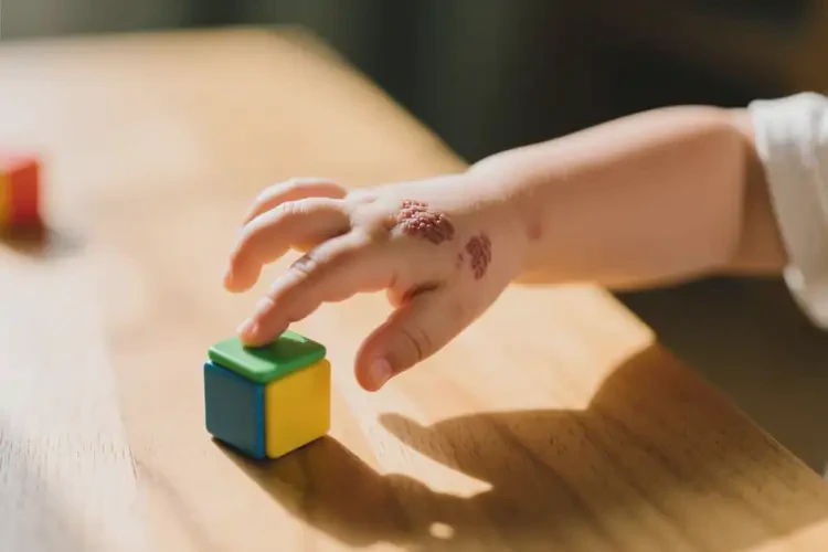 孩子手上出濕疹不管它會自己好嗎(圖3)