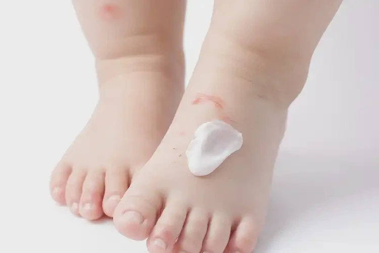 孩子腳上偶爾長濕疹能徹底自愈嗎(圖3)