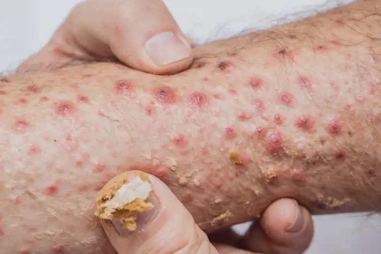 男性全身起濕疹可以徹底自愈嗎(圖4)