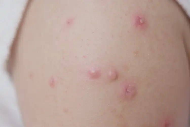 宝宝四肢长湿疹能够彻底治愈吗(图4)