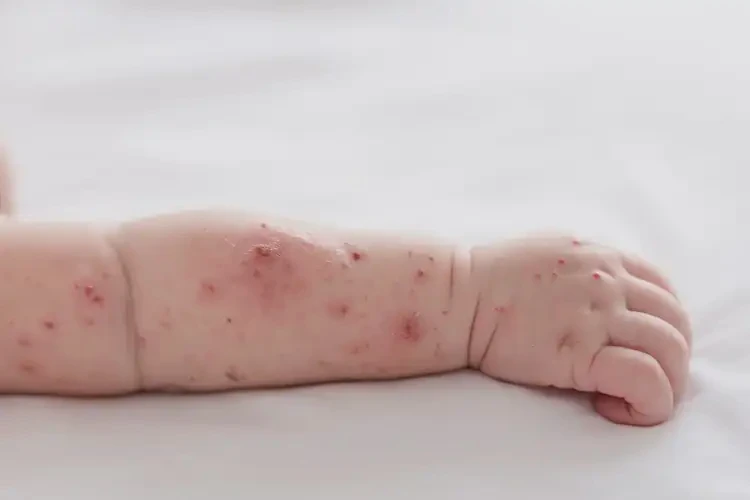 新生兒手臂上經(jīng)常長(zhǎng)濕疹能靠自己自愈嗎(圖3)