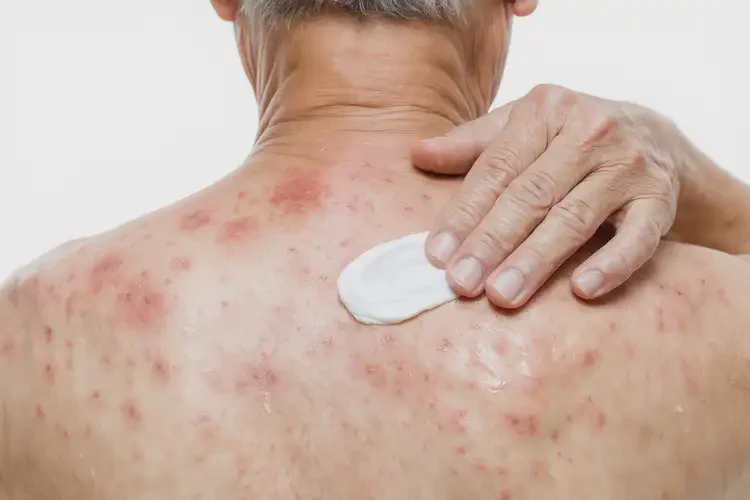 老年人脖子上出現(xiàn)濕疹能夠徹底治愈嗎(圖3)