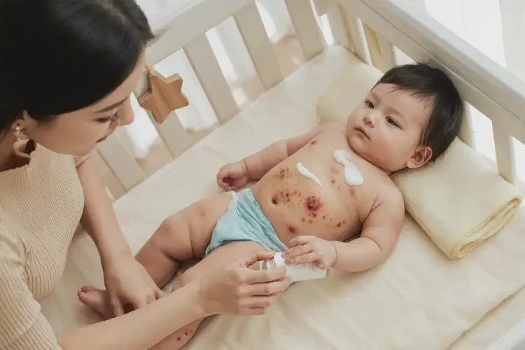 宝宝肚子上容易长湿疹能靠自己自愈吗(图2)