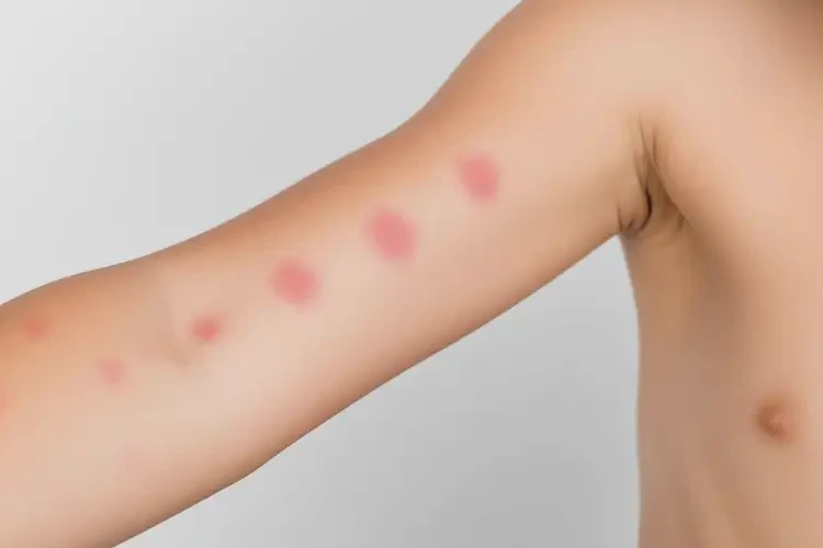 孩子手臂起湿疹可不可以彻底自愈(图4)