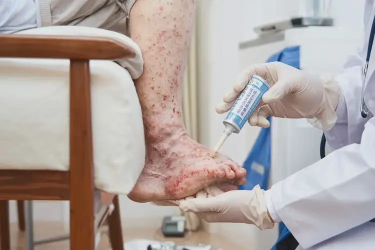 高齡老人腳上長濕疹能徹底自愈嗎(圖3)