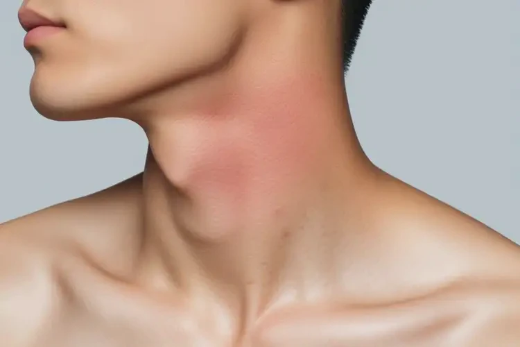 男生脖子上出濕疹不管它會(huì)自己痊愈嗎(圖4)