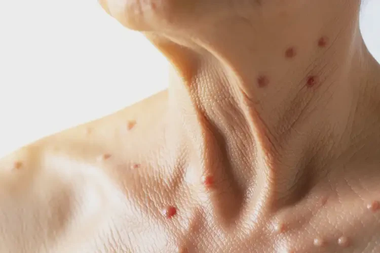 老年人脖子经常长湿疹不管它会自己自愈吗(图1)